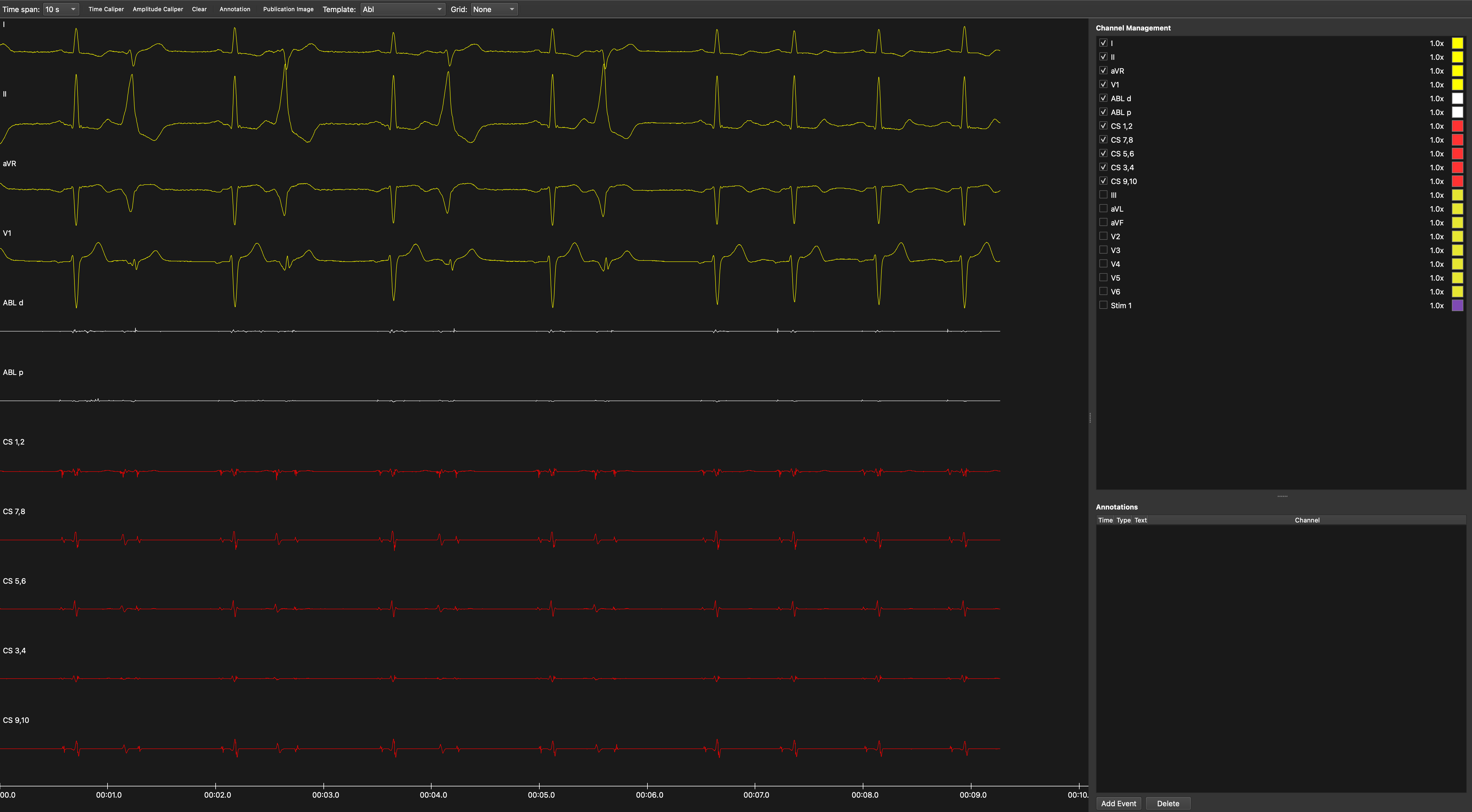 EAnalyzer displaying surface ECG and intracardiac tracings, with time controls, channel management, and the annotations panel.